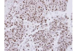 IHC-P Image Immunohistochemical analysis of paraffin-embedded OV90 xenograft, using FACA, antibody at 1:500 dilution. (FANCA anticorps  (N-Term))