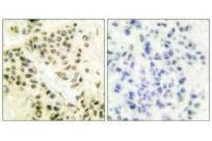 Immunohistochemical analysis of paraffin-embedded human breast carcinoma tissue using DNA-PK antibody. (PRKDC anticorps)