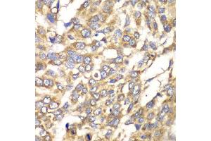 Immunohistochemistry of paraffin-embedded human esophageal cancer using VTI1B antibody at dilution of 1:100 (x40 lens). (VTI1B anticorps)