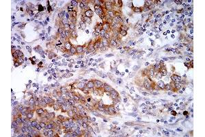 Immunohistochemical analysis of paraffin-embedded endometrial cancer tissues using VIMP mouse mAb with DAB staining.