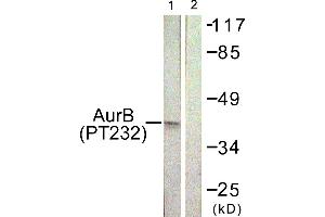Immunohistochemistry analysis of paraffin-embedded human liver carcinoma tissue using AurB (Phospho-Thr232) antibody. (Aurora Kinase B anticorps  (pThr232))