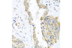 Immunohistochemistry of paraffin-embedded human lung cancer using DARS2 antibody at dilution of 1:100 (x40 lens). (DARS2 anticorps)