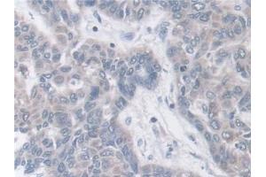 Detection of BCAR1 in Human Liver cancer Tissue using Polyclonal Antibody to Breast Cancer Anti-Estrogen Resistance 1 (BCAR1)