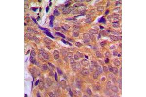 Immunohistochemical analysis of CHK1 staining in human breast cancer formalin fixed paraffin embedded tissue section.