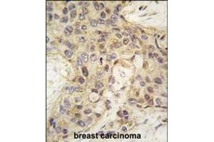 Formalin-fixed and paraffin-embedded human breast carcinoma tissue reacted with ANGEL2 antibody (Center) (ABIN389224 and ABIN2839377) , which was peroxidase-conjugated to the secondary antibody, followed by DAB staining. (ANGEL2 anticorps  (AA 108-138))