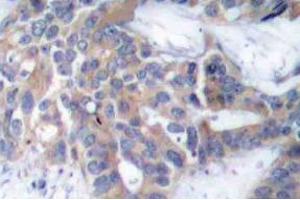 Immunohistochemistry (IHC) analyzes of p-MEK-1/2 antibody in paraffin-embedded human breast carcinoma tissue. (MEK1 anticorps  (pSer218, pSer222))
