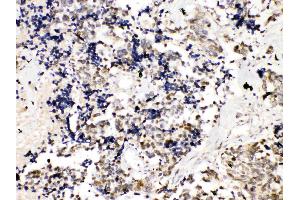 TRF2 was detected in paraffin-embedded sections of human lung cancer tissues using rabbit anti- TRF2 Antigen Affinity purified polyclonal antibody (Catalog # ) at 1 µg/mL. (TRF2 anticorps  (AA 81-287))