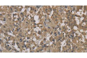 Immunohistochemistry of paraffin-embedded Human thyroid cancer tissue using DCTN3 Polyclonal Antibody at dilution 1:70 (DCTN3 anticorps)