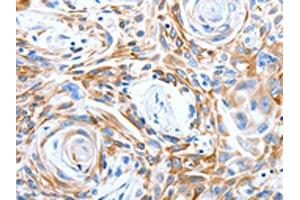 The image on the left is immunohistochemistry of paraffin-embedded Human esophagus cancer tissue using ABIN7191315(LRIG3 Antibody) at dilution 1/50, on the right is treated with synthetic peptide. (LRIG3 anticorps)