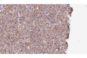 ABIN6273191 at 1/100 staining Human lymph cancer tissue by IHC-P. (alpha Adaptin anticorps  (Internal Region))