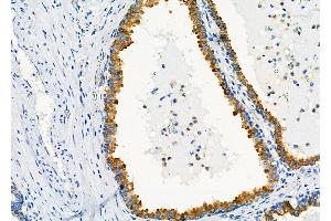 ABIN6258921 and ABIN6273360 at 1/100 staining Human prostate cancer by IHC-P. (GNG11 anticorps  (N-Term))
