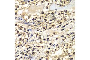 Immunohistochemistry of paraffin-embedded human kidney cancer using ZNF169 antibody at dilution of 1:100 (x400 lens).