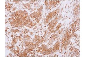 AP31125PU-N RGS10 antibody staining of Paraffin-Embedded Breast Carcinoma at 1/250 dilution. (RGS10 anticorps  (AA 1-160))