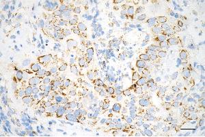 Immunohistochemistry was performed on paraffin-embedded human esophageal carcinoma using caspase 8 antibody (ABIN7797905), 1:100).