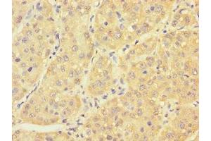 Immunohistochemistry of paraffin-embedded human liver cancer using ABIN7166614 at dilution of 1:100 (PCBD1 anticorps  (AA 2-104))