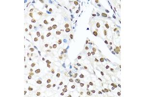 Immunohistochemistry of paraffin-embedded human prostate cancer using Ku80 antibody (ABIN6130932, ABIN6150308, ABIN6150310 and ABIN6217336) at dilution of 1:100 (40x lens). (XRCC5 anticorps  (AA 540-732))