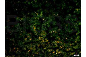 Formalin-fixed and paraffin-embedded human liver carcinoma labeled with Anti-MRP2 Polyclonal Antibody, Unconjugated (ABIN737541) 1:200, overnight at 4°C, The secondary antibody was Goat Anti-Rabbit IgG,PE conjugated used at 1:200 dilution for 40 minutes at 37°C.