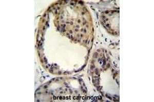 AKT1 antibody (Thr308) immunohistochemistry analysis in formalin fixed and paraffin embedded human breast carcinoma followed by peroxidase conjugation of the secondary antibody and DAB staining. (AKT1 anticorps  (AA 289-318))