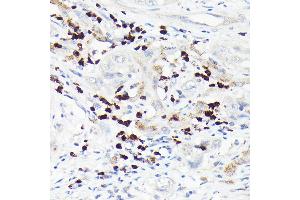 Immunohistochemistry of paraffin-embedded human liver cancer using MMP8 Rabbit pAb (ABIN3015770, ABIN3015771, ABIN3015772 and ABIN6219115) at dilution of 1:150 (40x lens). (MMP8 anticorps  (AA 101-467))
