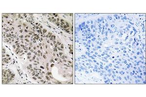 Immunohistochemistry analysis of paraffin-embedded human lung carcinoma tissue using TNNI3K antibody. (TNNI3K anticorps  (Internal Region))