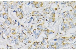 Immunohistochemistry of paraffin-embedded Human breast cancer using ATP5J Polyclonal Antibody at dilution of 1:100 (40x lens).