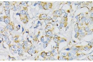 Immunohistochemistry of paraffin-embedded Human breast cancer using ATP5J Polyclonal Antibody at dilution of 1:100 (40x lens). (ATP5J anticorps)
