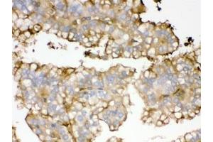 IHC testing of FFPE human kidney cancer tissue with APOA1 antibody. (APOA1 anticorps)