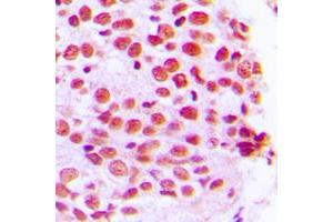 Immunohistochemical analysis of PE2 staining in human breast cancer formalin fixed paraffin embedded tissue section. (ERF anticorps  (C-Term))