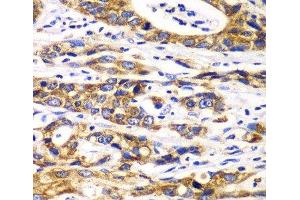 Immunohistochemistry of paraffin-embedded Human gastric cancer using RPN1 Polyclonal Antibody at dilution of 1:100 (40x lens). (RPN1 anticorps)
