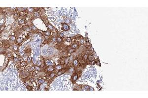 ABIN6277791 at 1/100 staining Human Head and neck cancer tissue by IHC-P. (CD11c anticorps  (N-Term))