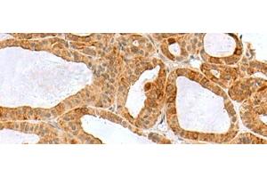 Immunohistochemistry of paraffin-embedded Human thyroid cancer tissue using RPS16 Polyclonal Antibody at dilution of 1:60(x200) (RPS16 anticorps)