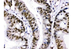 CRM1 was detected in paraffin-embedded sections of human intestinal cancer tissues using rabbit anti- CRM1 Antigen Affinity purified polyclonal antibody (Catalog # ) at 1 µg/mL.