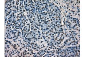 Immunohistochemical staining of paraffin-embedded Carcinoma of kidney tissue using antiHSPA9mouse monoclonal antibody. (HSPA9 anticorps)