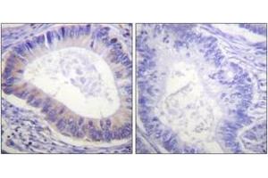 Immunohistochemistry analysis of paraffin-embedded human colon carcinoma, using PDE4D (Phospho-Ser190/53) Antibody.