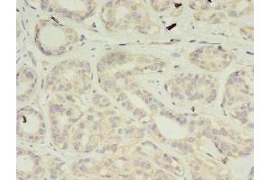 Immunohistochemistry of paraffin-embedded human breast cancer using ABIN7175188 at dilution of 1:100