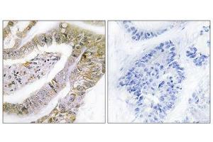 Immunohistochemistry analysis of paraffin-embedded human lung carcinoma tissue using TACC3 antibody. (TACC3 anticorps  (C-Term))