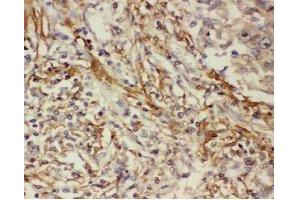 Immunohistochemistry analysis of paraffin-embedded human lung cancer tissue using COX2 Antibody (1/200 dilution). (COX2 anticorps)