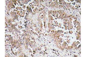Immunohistochemical analysis of paraffin-embedded human lung cancer tissue using OR6P1 polyclonal antibody . (OR6P1 anticorps)