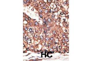 Formalin-fixed and paraffin-embedded human hepatocellular carcinoma tissue reacted with LEPR polyclonal antibody  , which was peroxidase-conjugated to the secondary antibody, followed by DAB staining. (Leptin Receptor anticorps  (N-Term))