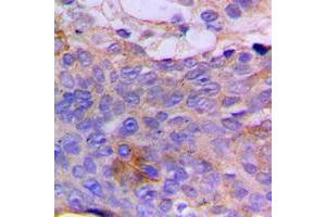 Immunohistochemical analysis of CSGALNACT1 staining in human breast cancer formalin fixed paraffin embedded tissue section. (CSGALNACT1 anticorps  (Center))