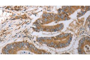 Immunohistochemistry of paraffin-embedded Human colon cancer using SLC22A6 Polyclonal Antibody at dilution of 1:40