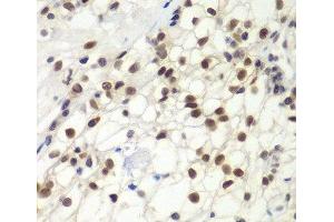 Immunohistochemistry of paraffin-embedded Human kidney cancer using MSH6 Polyclonal Antibody at dilution of 1:100 (40x lens). (MSH6 anticorps)