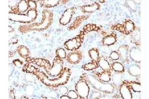 IHC testing of FFPE human renal cell carcinoma with recombinant Cadherin 16 antibody (clone CDH16/1532R). (Recombinant Cadherin-16 anticorps)