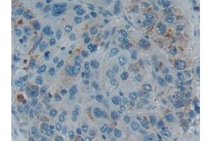 Detection of SMAD5 in Human Liver cancer Tissue using Polyclonal Antibody to SMAD family member 5 (SMAD5)