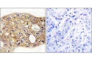 Immunohistochemistry analysis of paraffin-embedded human breast carcinoma tissue, using AGR3 Antibody. (AGR3 anticorps  (AA 1-50))