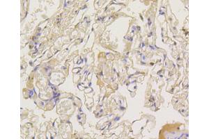 Immunohistochemistry of paraffin-embedded human lung using ARRB1 antibody (ABIN5996907) at dilution of 1/100 (40x lens). (beta Arrestin 1 anticorps)