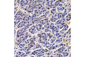 Immunohistochemistry of paraffin-embedded human liver cancer using HIRIP3 antibody (ABIN5974221) at dilution of 1/100 (40x lens). (HIRIP3 anticorps)