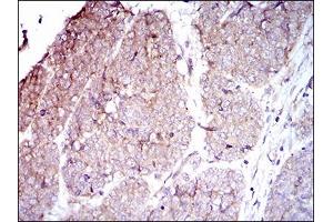 Immunohistochemical analysis of paraffin-embedded esophageal cancer tissues using ITGB4 mouse mAb with DAB staining. (Integrin beta 4 anticorps  (AA 1619-1822))