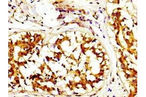 IHC image of ABIN7146664 diluted at 1:200 and staining in paraffin-embedded human breast cancer performed on a Leica BondTM system. (Caprin-1 anticorps  (AA 573-703))