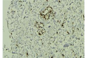 ABIN6272857 at 1/100 staining Human breast cancer tissue by IHC-P. (VPRBP anticorps)